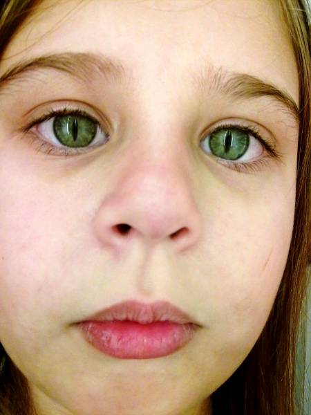 Cat eye syndrome