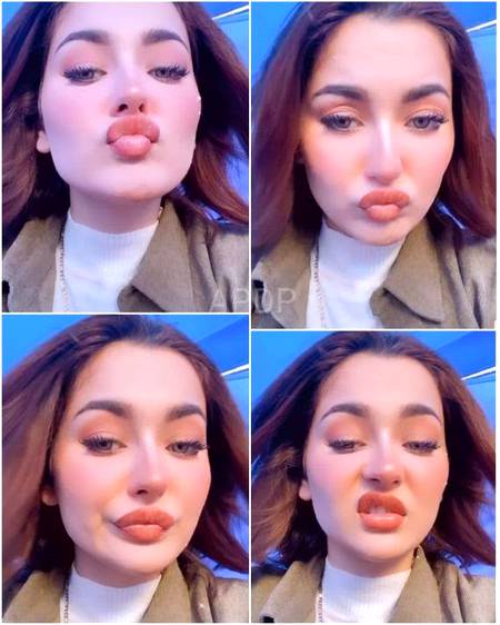 Hania Aamir Had Lip Fillers