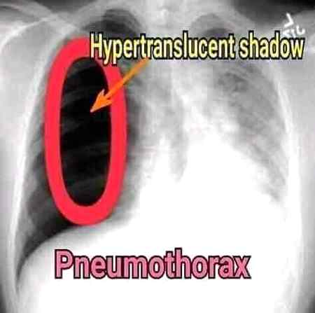Pneumothorax...