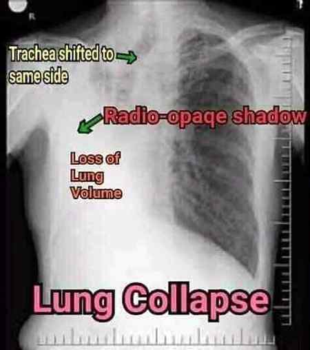 Xrays finding of lung collapse...loss of lung volume