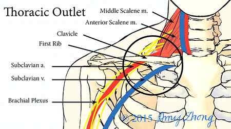 Thoracic outlet syndrome