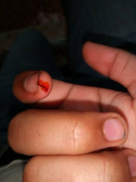 Bht dard hai ungali me