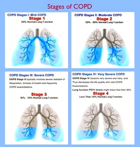 Stages of chronic obstructive pulmonary disease
